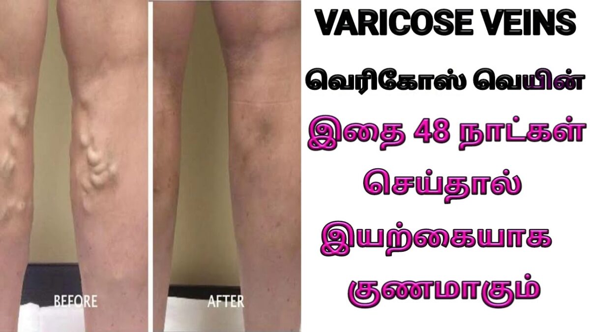 Do this only 1 time to get rid of varicose veins!! 100% Solution Simple Home Remedies!!