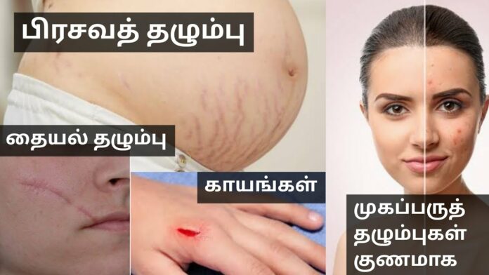 Try this home remedy to get rid of body scars fast!!