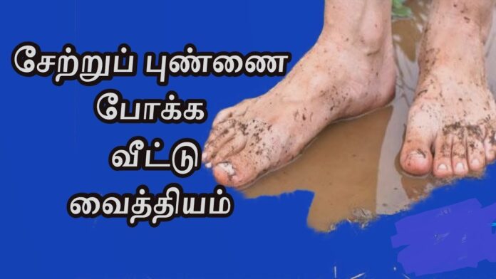 Simple Home Remedies to Get Rid of Calluses on Your Feet!! Try it immediately to get a permanent solution!!