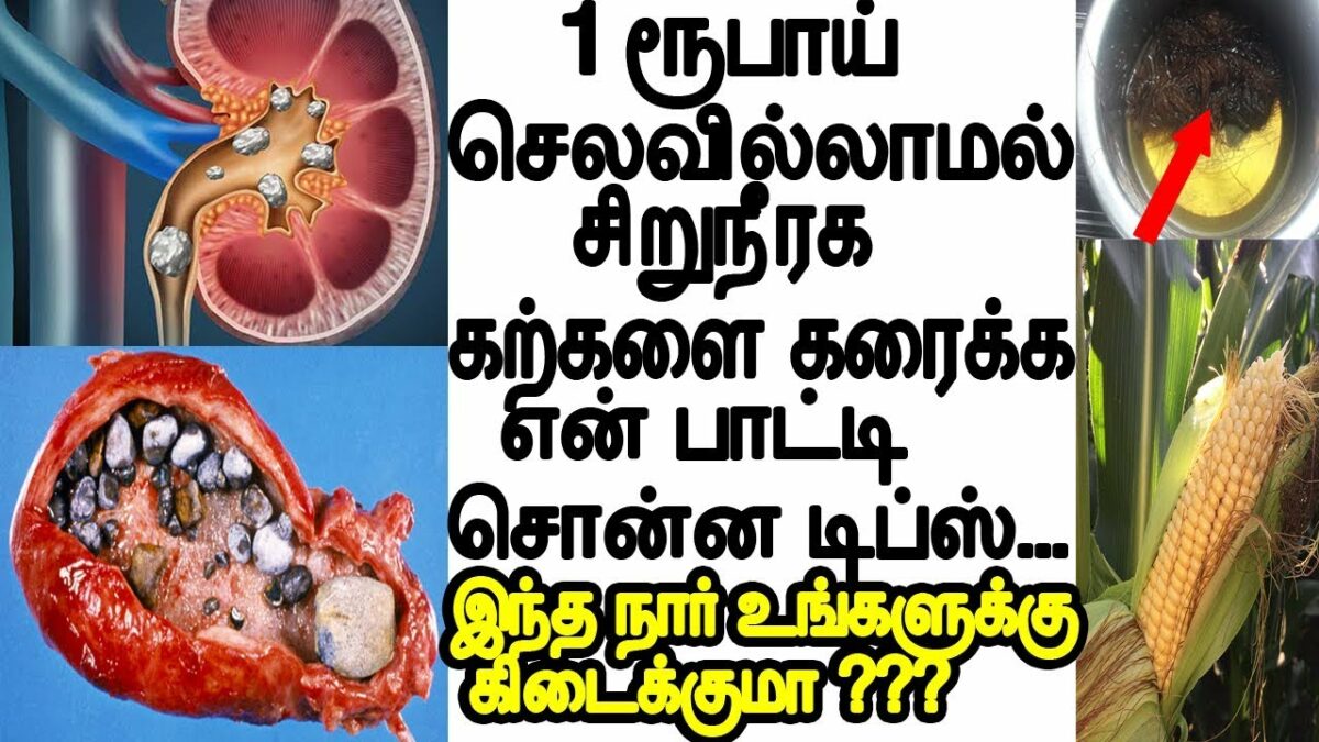 Dissolve kidney stone easily without medicine!! Drink this 1 drink!!