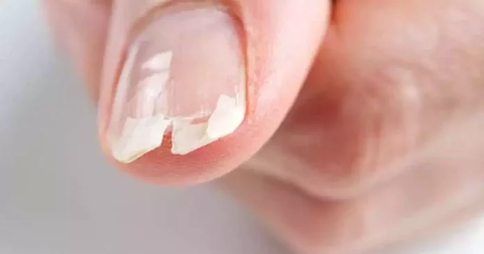 Are your nails like this? It could be symptoms of that disease!