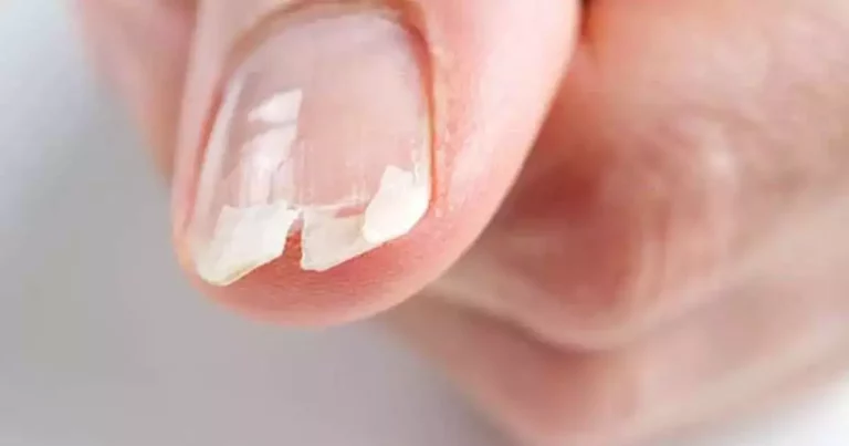 Are your nails like this? It could be symptoms of that disease!