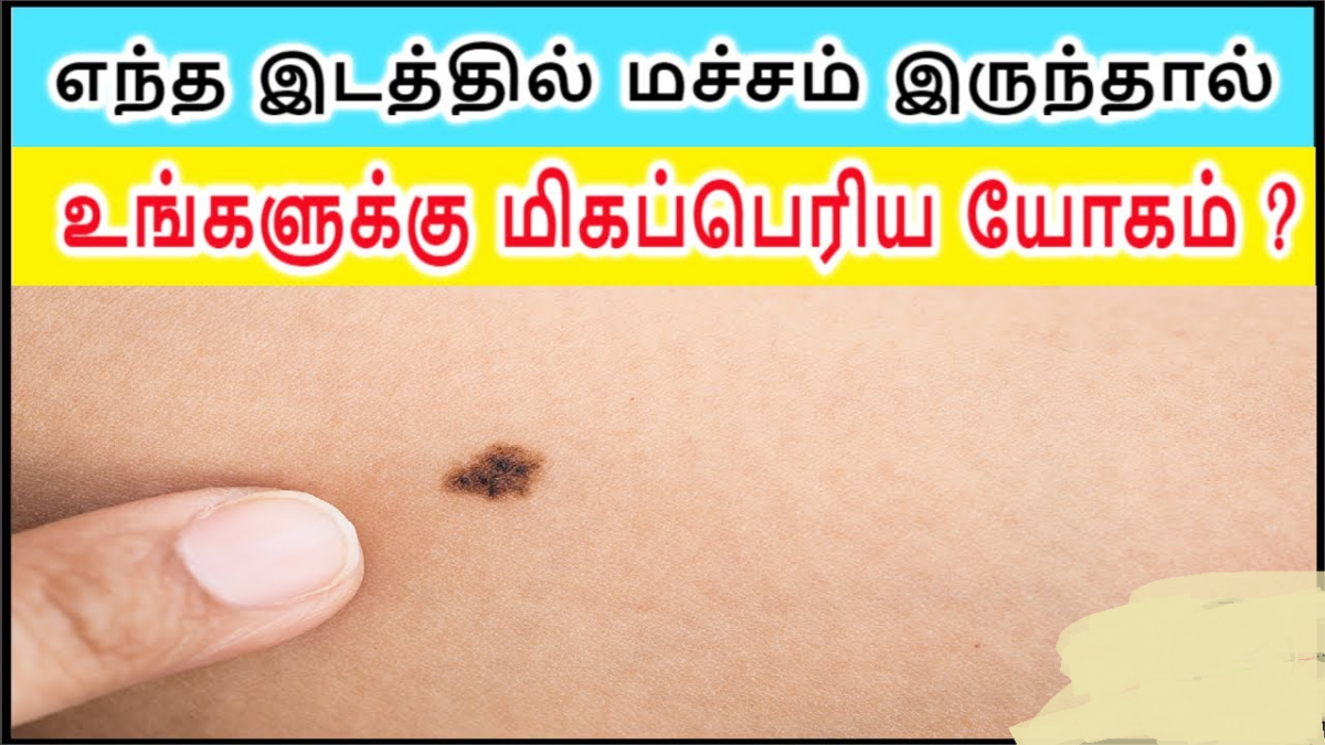 Lucky benefits of moles!! Check if you have a mole in that area!!