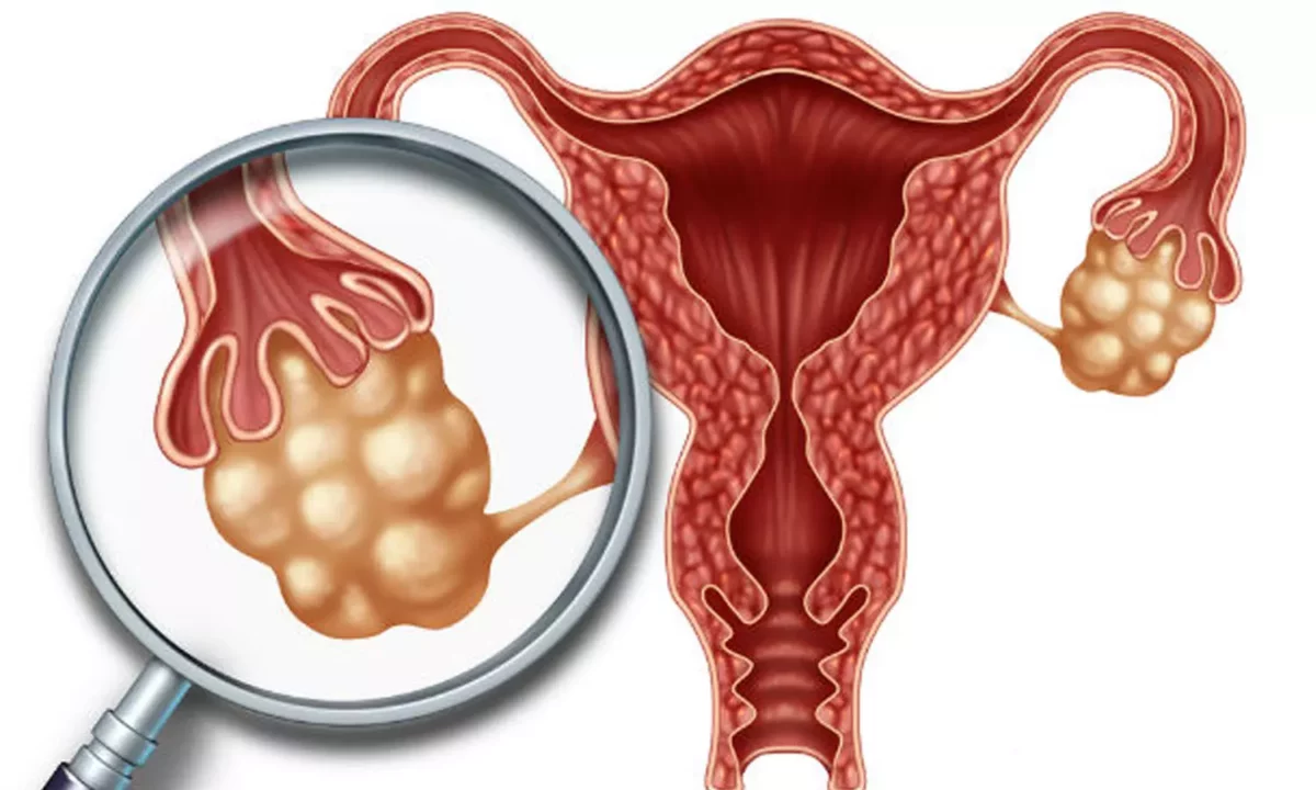 Cure Uterine Cyst Without Surgery.. These Home Remedies Will Help!!