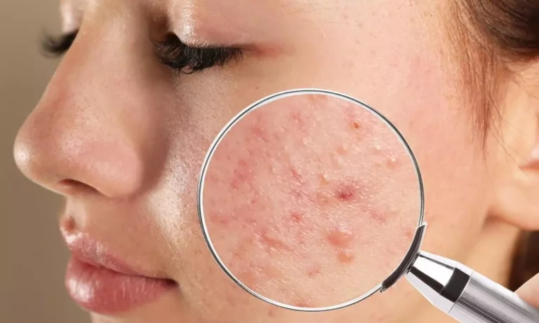 Mix this with honey and apply it in 1 week of acne!! No more cream needed!!