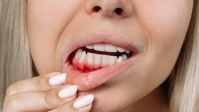 Natural tips to get rid of bleeding gums!! Try it today!!