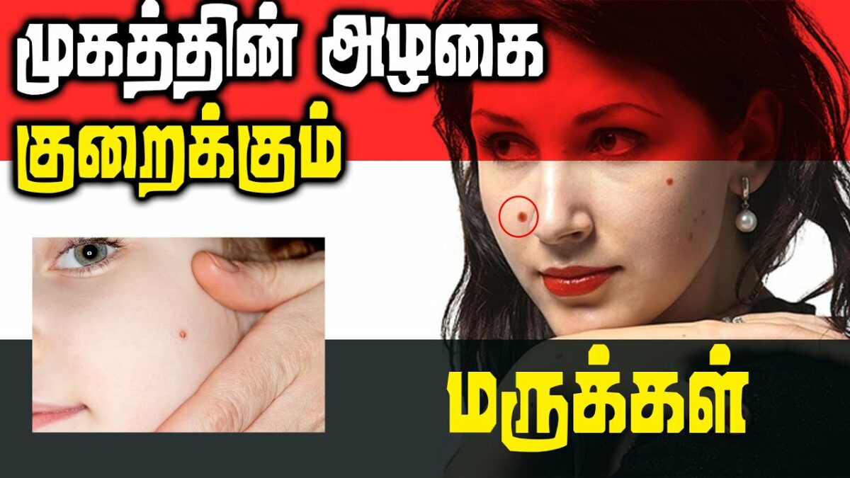 Warts that spoil the beauty of the skin! Here are the easy ways to get rid of it!!