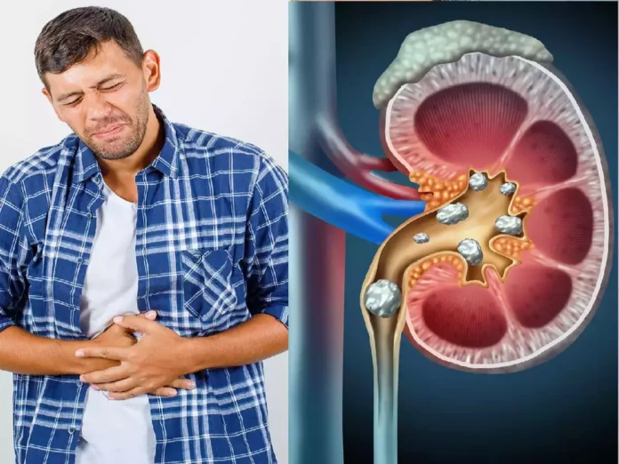 Just do this to remove kidney stone painlessly without surgery!!