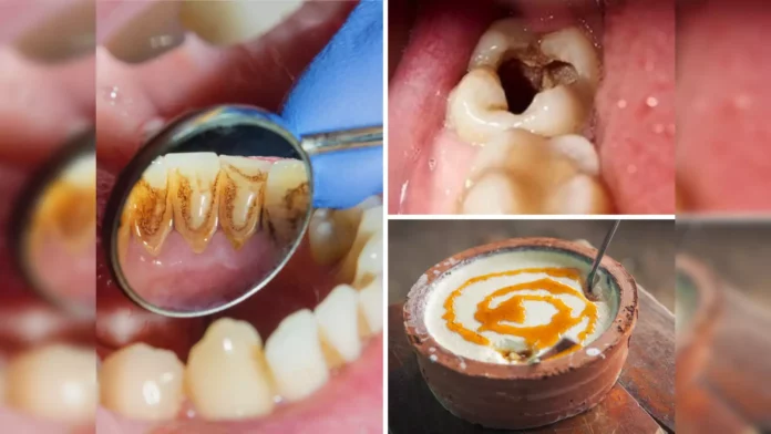 To remove hard stains from teeth