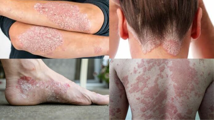 Early symptoms of Psoriasis are like this, get checked immediately!!