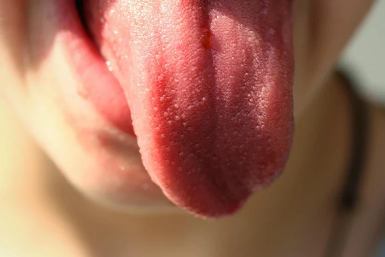 Warning.. If your tongue color is like this it will be life threatening!!