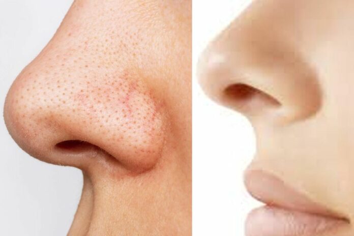 Try this home remedy to get rid of dark spots on nose!!