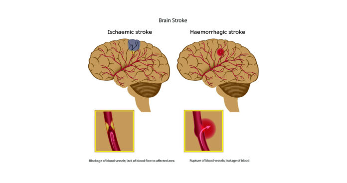 BRAIN STROKE: People with this blood type have a high chance of having a brain stroke!! Warning doctors!