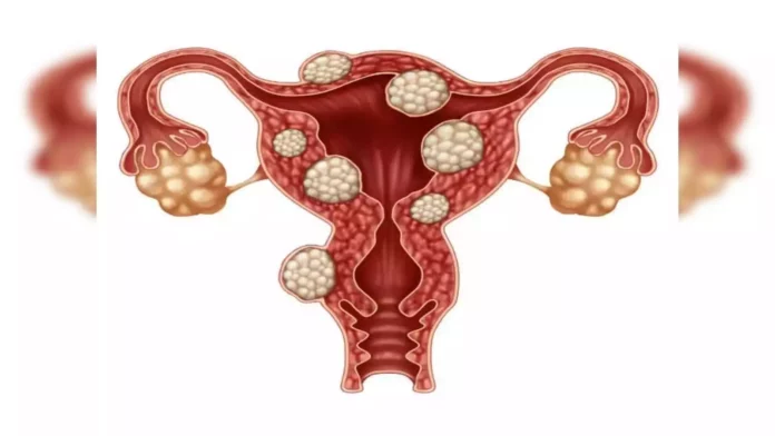 UTERINE FIBROIDS: How to prepare herbal decoction to dissolve uterine fibroids?