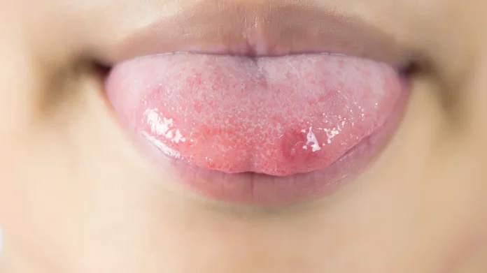 Do you often get sore tongue? Then it may be the impact of this disease!