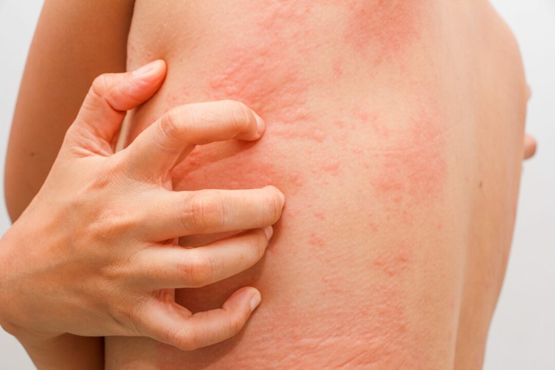 Simple Natural Remedies for Skin Diseases like Rash Scabies!!