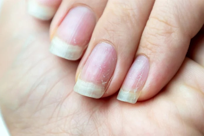 If there is too much bad cholesterol in the body.. these symptoms can be seen in the nails!!