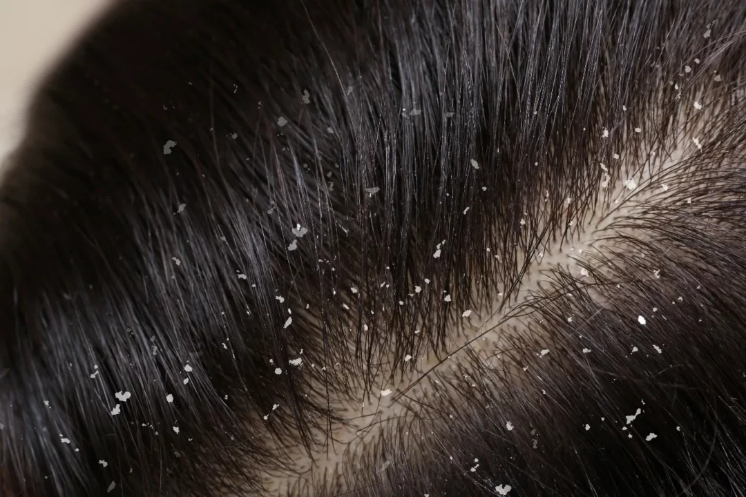 Excessive scalp dandruff? Grind and rub these two ingredients!!