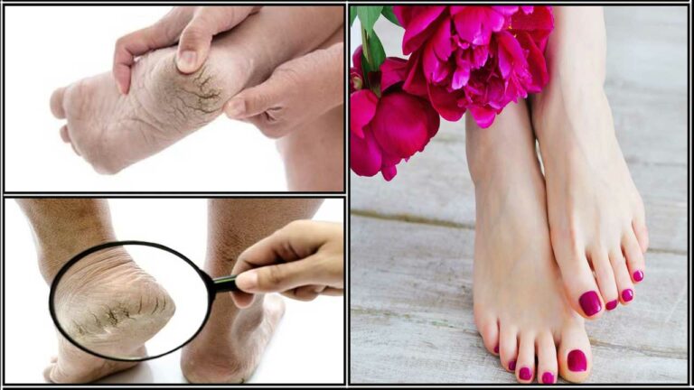 This one product helps heal winter heel spurs in 7 days!!