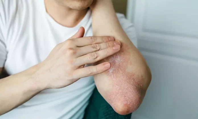 here-are-the-best-home-remedies-for-psoriasis-from-experts