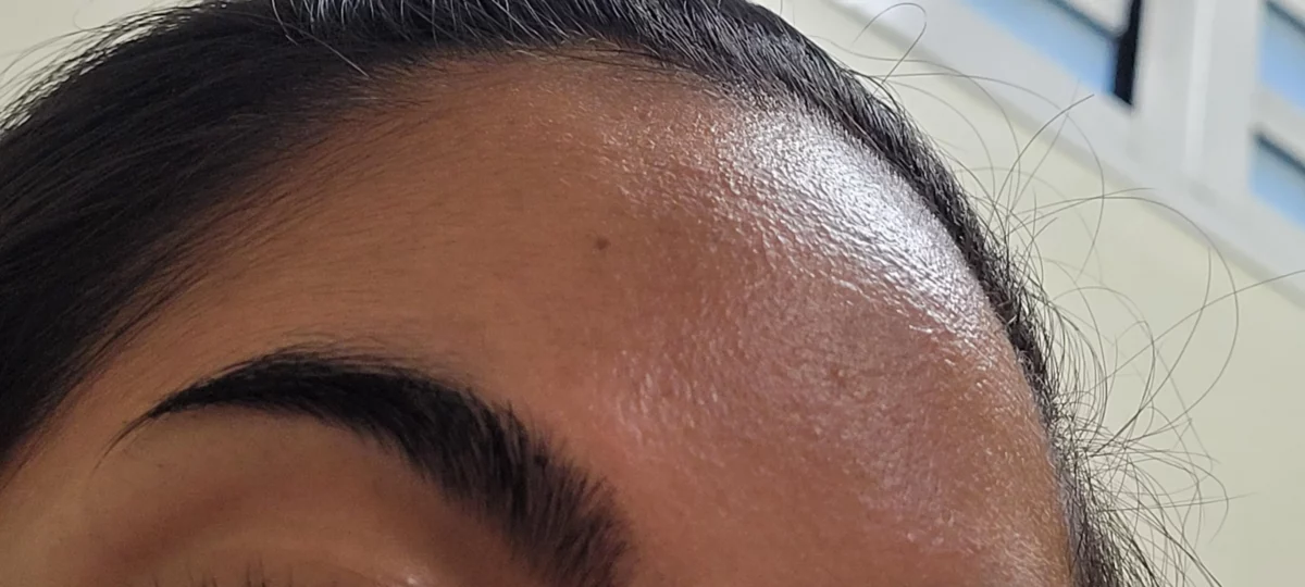 Use this one oil to get rid of forehead hair fall and grow new hair in one week!!