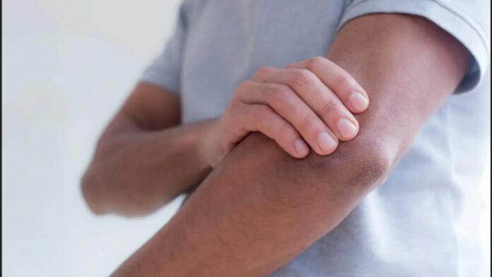 Find out! Useful Home Remedies to Cure Hand and Foot Scabies!!
