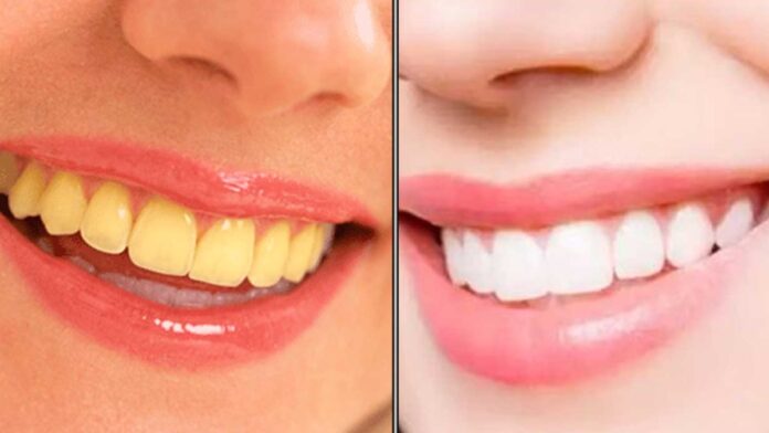 This paste is enough.. the yellow plaques on the teeth will come off automatically!!