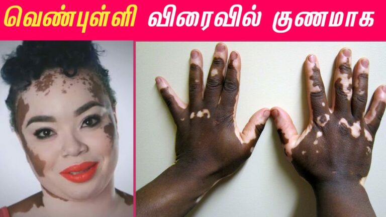 தேமல் வெண்புள்ளிகள் மீது இந்த எண்ணெயை தடவினால்.. இருந்த இடம் தெரியாமல் மறைந்துவிடும்!!