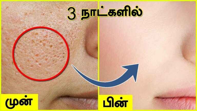 முகத்தில் உள்ள OPEN PORES ஆல் கவலையா? அழகான தோற்றம் கிடைக்க.. இந்த க்ரீமை யூஸ் பண்ணுங்க!!