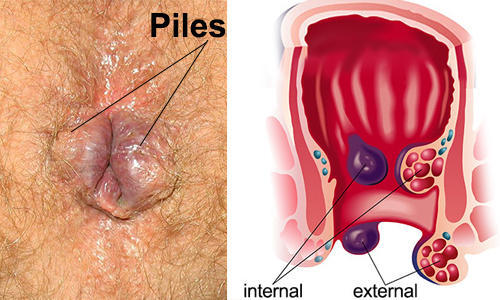 பைல்ஸ் பாதிப்பை இல்லாமல் ஆக்கும் முடக்கத்தான்!! இந்த முறையில் பயன்படுத்தி 100% பலனை பெறுங்கள்!!