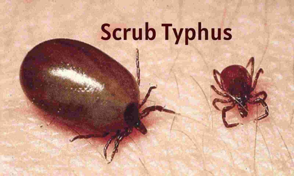 health department has warned that scrub typhus fever is spreading in Tamil Nadu