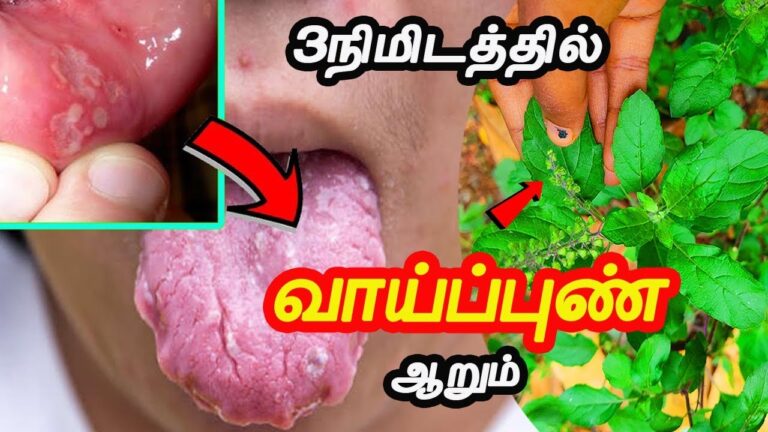 வாய் அல்சர் புண்கள் குணமாக.. இந்த கீரையை பச்சையாக மென்று சாப்பிடுங்கள் போதும்!!