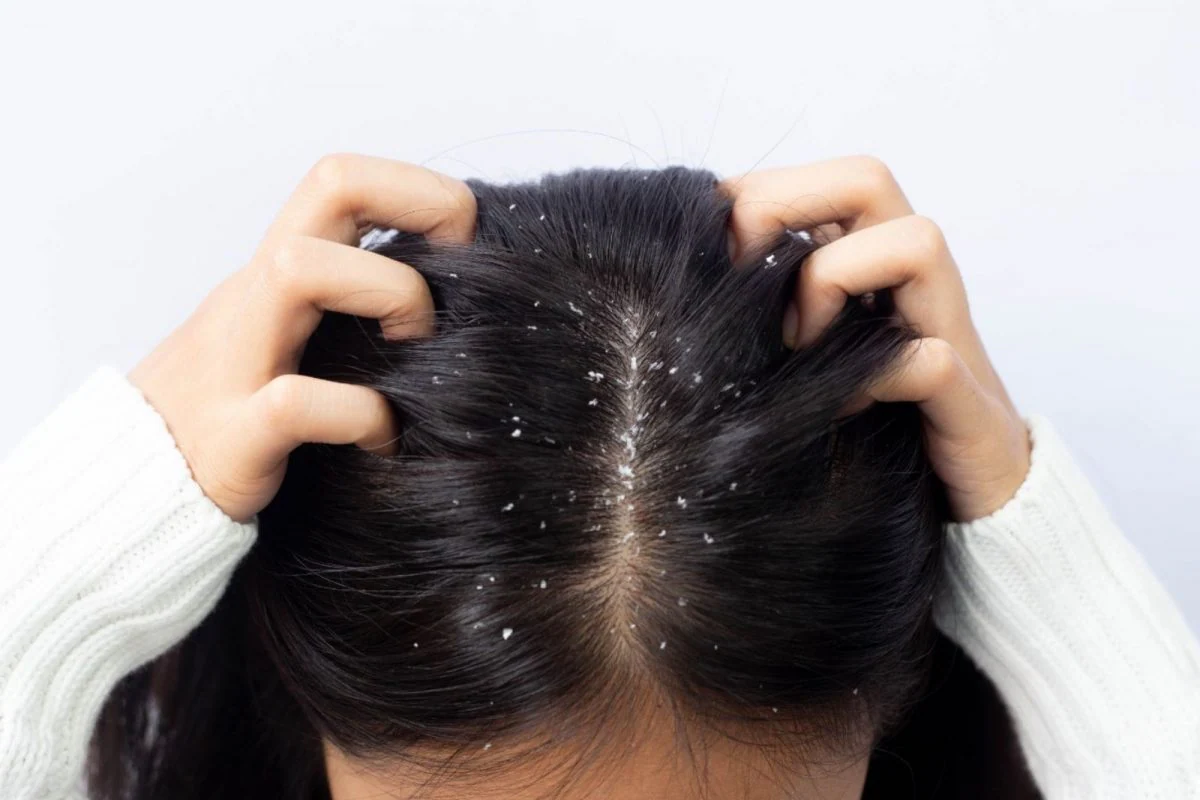 do-you-have-a-lot-of-dandruff-on-your-scalp-try-natural-ways-to-get-rid-of-it-completely