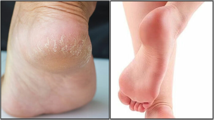 Amazing solution for cracked heels!! This oil is enough.. You will get results in first try!!