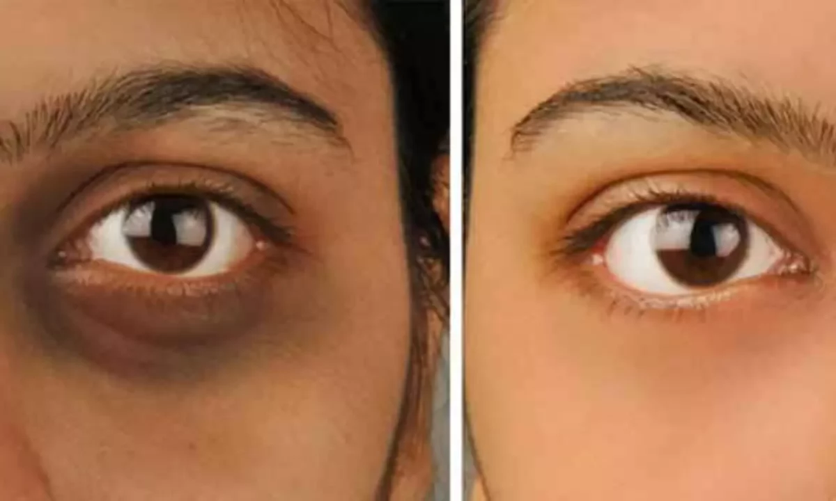 Do you have dark circles under your eyes!! Don't know how to get rid of them!!