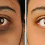 Do you have dark circles under your eyes!! Don't know how to get rid of them!!