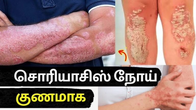 சொரியாசிஸில் இருந்து 100% விடுதலை கிடைக்க.. இந்த இலையை அரைத்து பூசுங்கள்!!