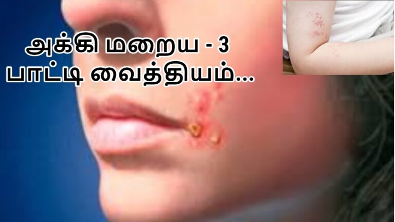இரண்டே நாளில் அக்கி புண்கள் குணமாக.. நம் பவர்புல் பாட்டி வைத்தியத்தை பின்பற்றுங்கள்!!