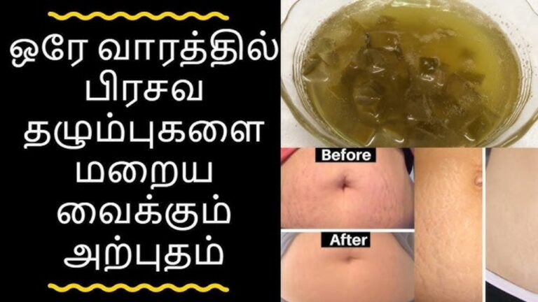 பிரசவித்த பிறகு தென்படும் Stretch Marks ஒரு வாரத்தில் மறைய.. இந்த பேஸ்டை வயிற்றில் பூசுங்கள்!!