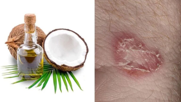 தேமல் முதல் படை வரையிலான தோல் பிரச்சனை சரியாக.. இந்த எண்ணெயை பயன்படுத்துங்கள்!!