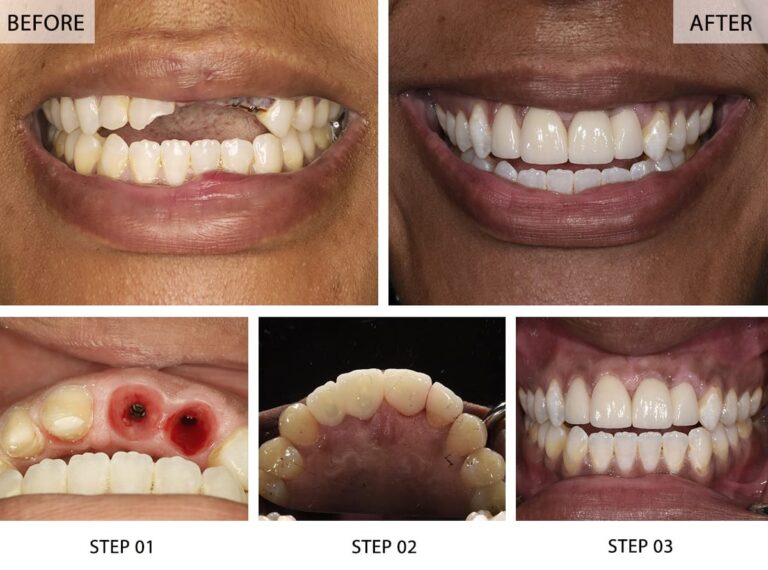 Dental implant: பல் இம்பிளாண்ட் சிகிச்சை முறை நல்லதா கெட்டதா? முழு விவரம் உள்ளே!!