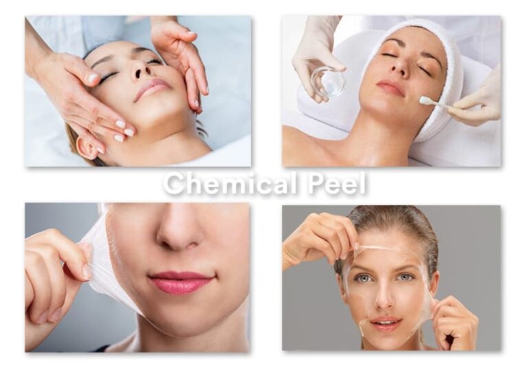 CHEMICAL PEEL சிகிச்சையை வீட்டில் செய்யலாமா? கெமிக்கல் பீல் மூலம் நிறத்தை மாற்ற முடியுமா?