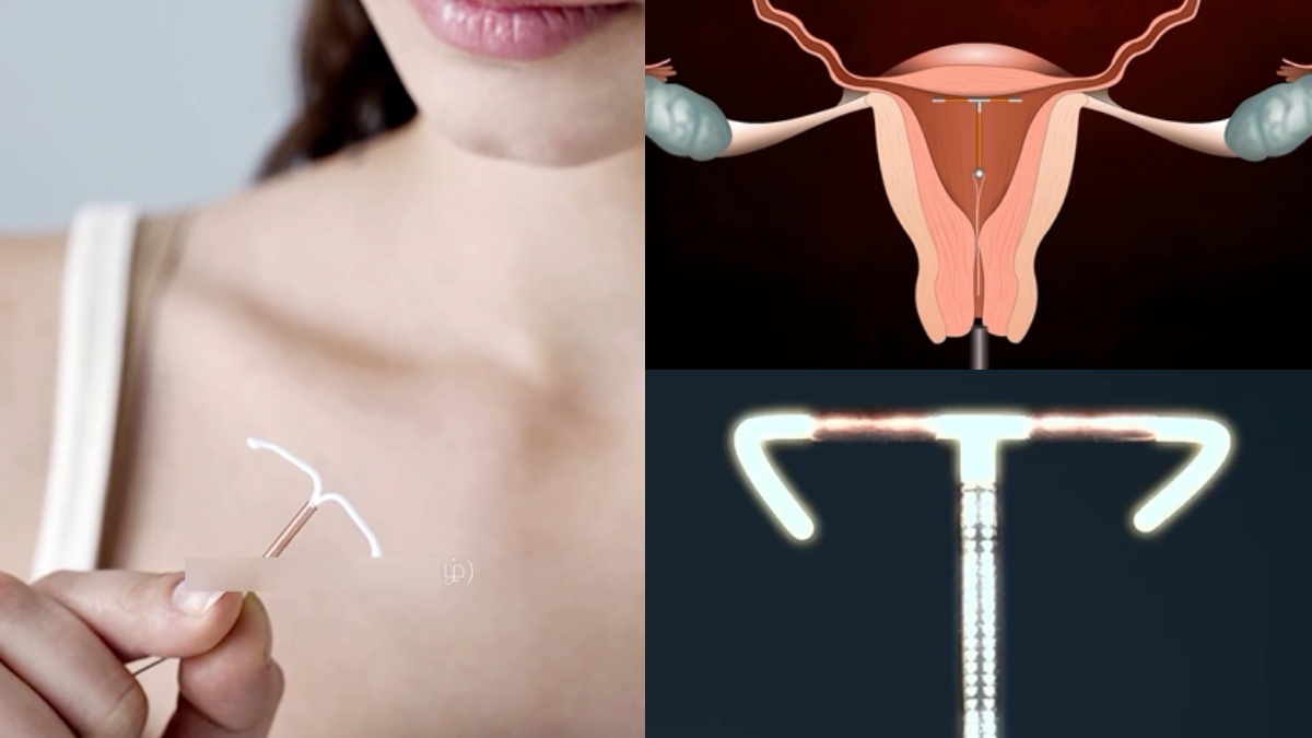 Are you using copper T for birth control!!its benefits and side effects!!