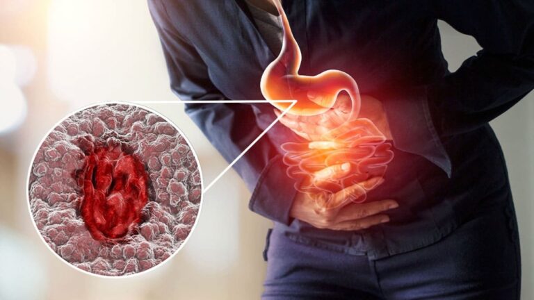 எச்சரிக்கை.. இந்த உணவுப்பழக்கம் ULCER-ஐ உண்டாக்கலாம்!! என்ன சாப்பிட்டால் கியூர் ஆகும்?