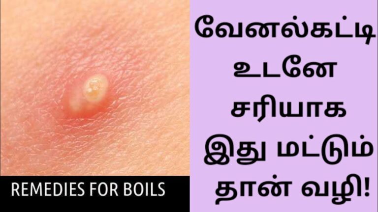 உடல் சூட்டால் வரும் கட்டிகளை மறைய வைக்கும் “சொடக்கு தக்காளி”!! இந்த பொருளையும் சேர்த்துக்கோங்க!!
