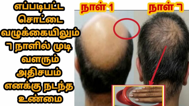 வழுக்கையான தலையில் முடி முளைக்க செலவு இல்லாத சிம்பிள் டிப்ஸ்!! இன்னைக்கே ஸ்டார்ட் பண்ணுங்க!!