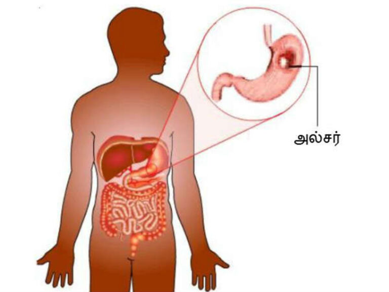 Ulcer உள்ளவர்கள் 5 மில்லி இந்த எண்ணெய் உட்கொண்டால் வயிற்றுப் புண்கள் சீக்கிரம் குணமாகும்!!