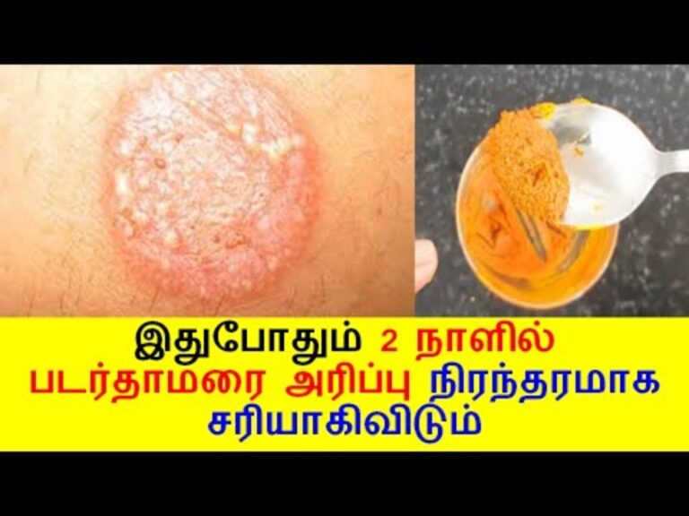 ஒரே நாளில் படர் தாமரை மறைய.. குப்பைமேனி கீழாநெல்லி இலையை இந்த மாதிரி பண்ணுங்க!!