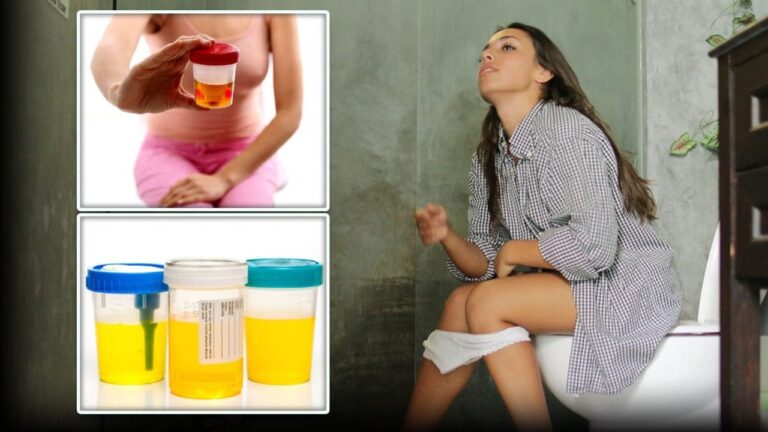 உங்கள் சிறுநீர் டார்க் மஞ்சள் கலரில் இருக்கா? இதற்கான காரணமும் எளிய தீர்வும்!!