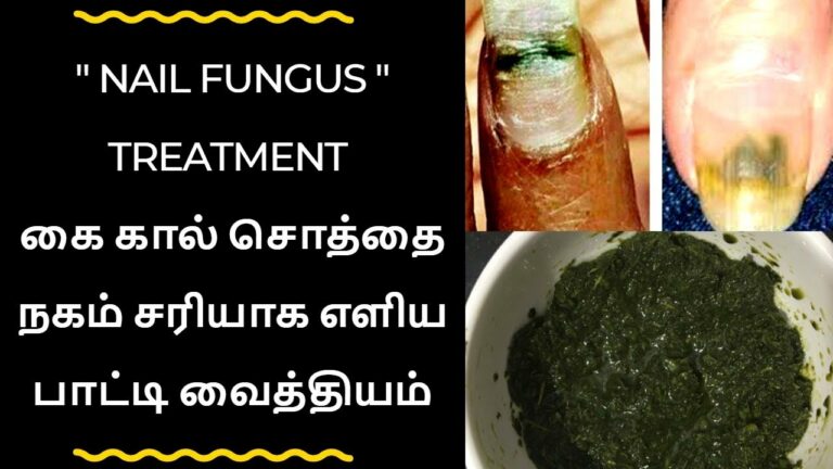சொத்தை நகத்தின் மீது இதை தடவினால்.. ஒரே இரவில் தீர்வு கிடைத்துவிடும்!!